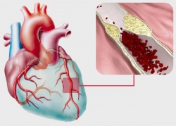  заболевания сердечно сосудистой системы, симптомы болезни сердца, миокард лечение, профилактика сердечно сосудистых заболеваний, лечение болезней сердца, ишемическая болезнь сердца лечение,  атеросклеротическая болезнь сердца, 